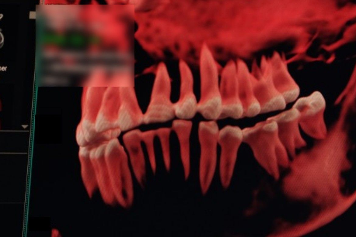 A fiatal nő fogazatának CT-rekonstrukciója. Fotó: Gerber Dániel