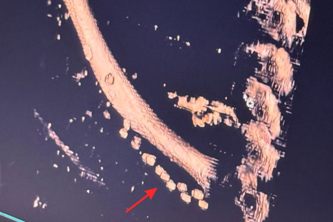 Ruha díszítőelemei (gyöngyök) a jobb oldali kulcscsont mellett. Fotó: Gerber Dániel